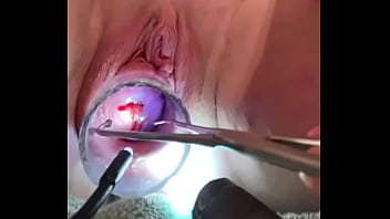 blackangel anal speculum and prolapse
